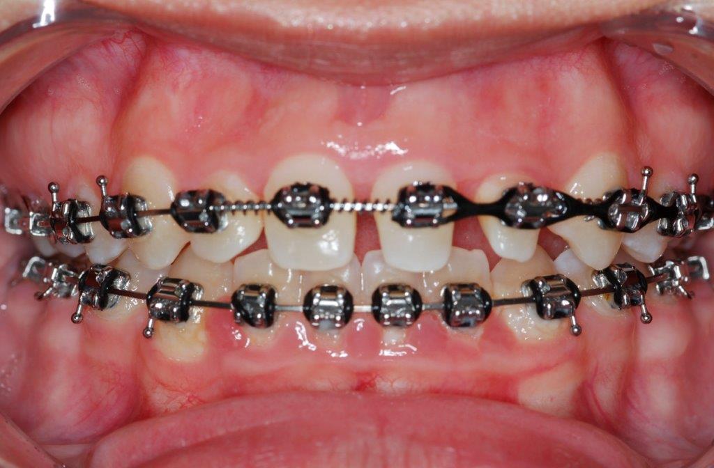 Case 14: before dental treatment