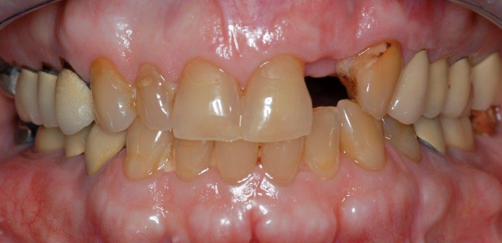 Case 17: before dental treatment