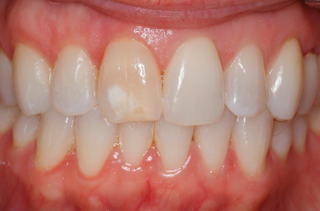 Case 22: before dental treatment