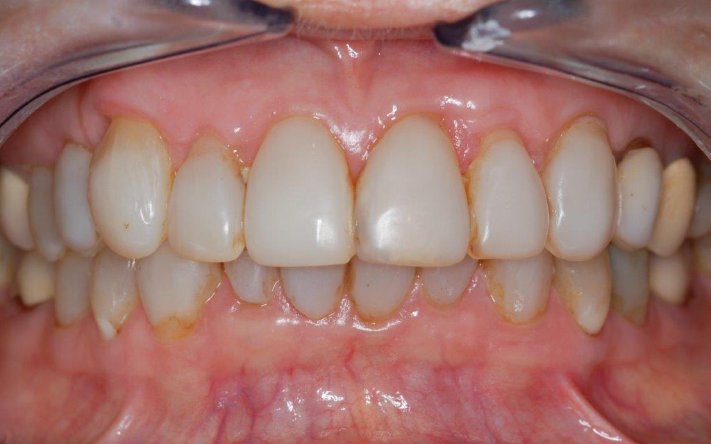 Case 24: before dental treatment
