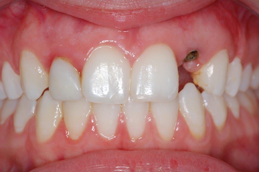 Case 4: before dental treatment