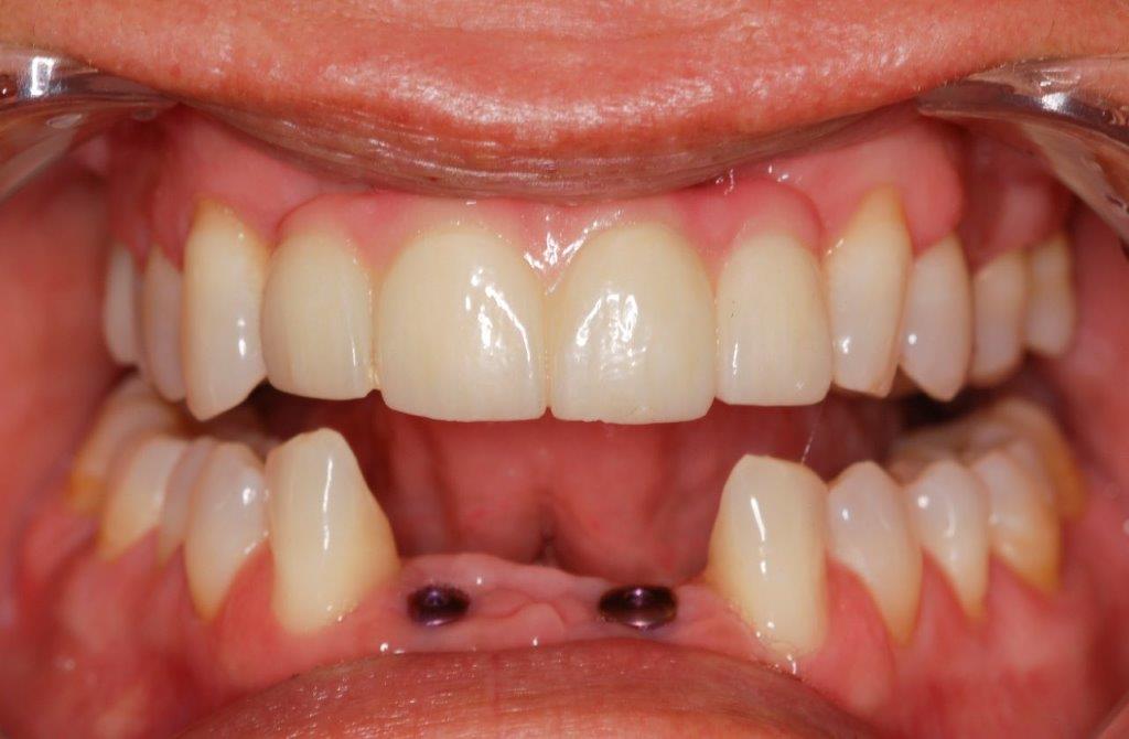 Case 6: before dental treatment