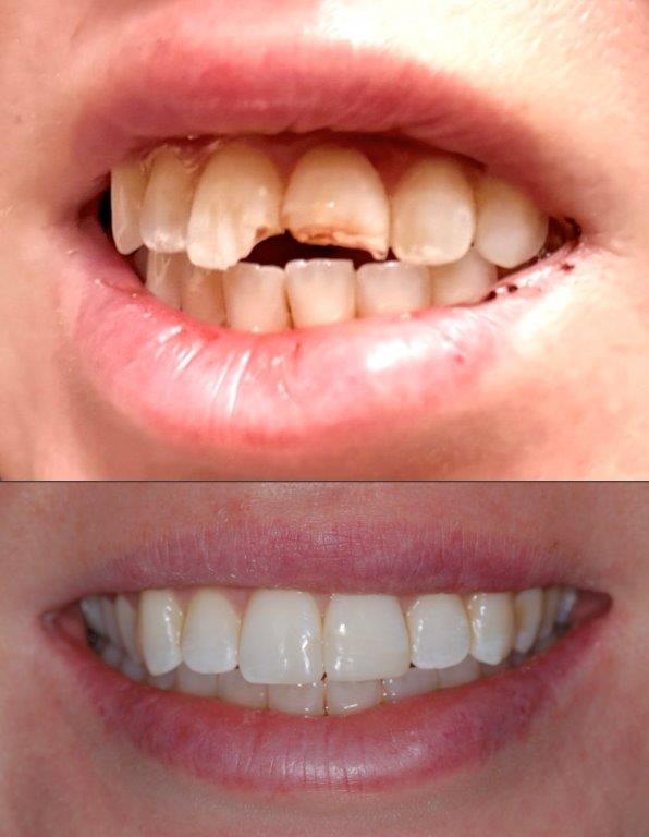 Emergency bonding case 1: damaged front teeth before treatment at the top, and restored front teeth after bonding below