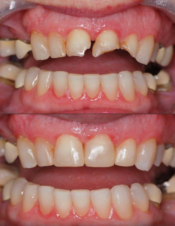 Emergency bonding case 2: damaged front teeth before treatment at the top, and restored front teeth after bonding below